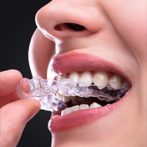 Aligner Tedavisi